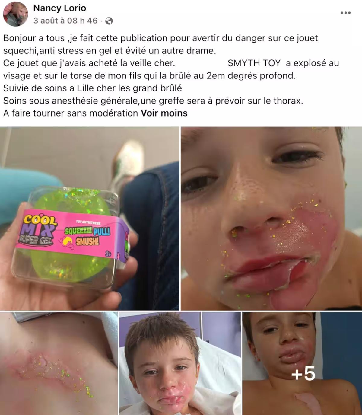 Un enfant de 8 ans brûlé par un jouet squishy