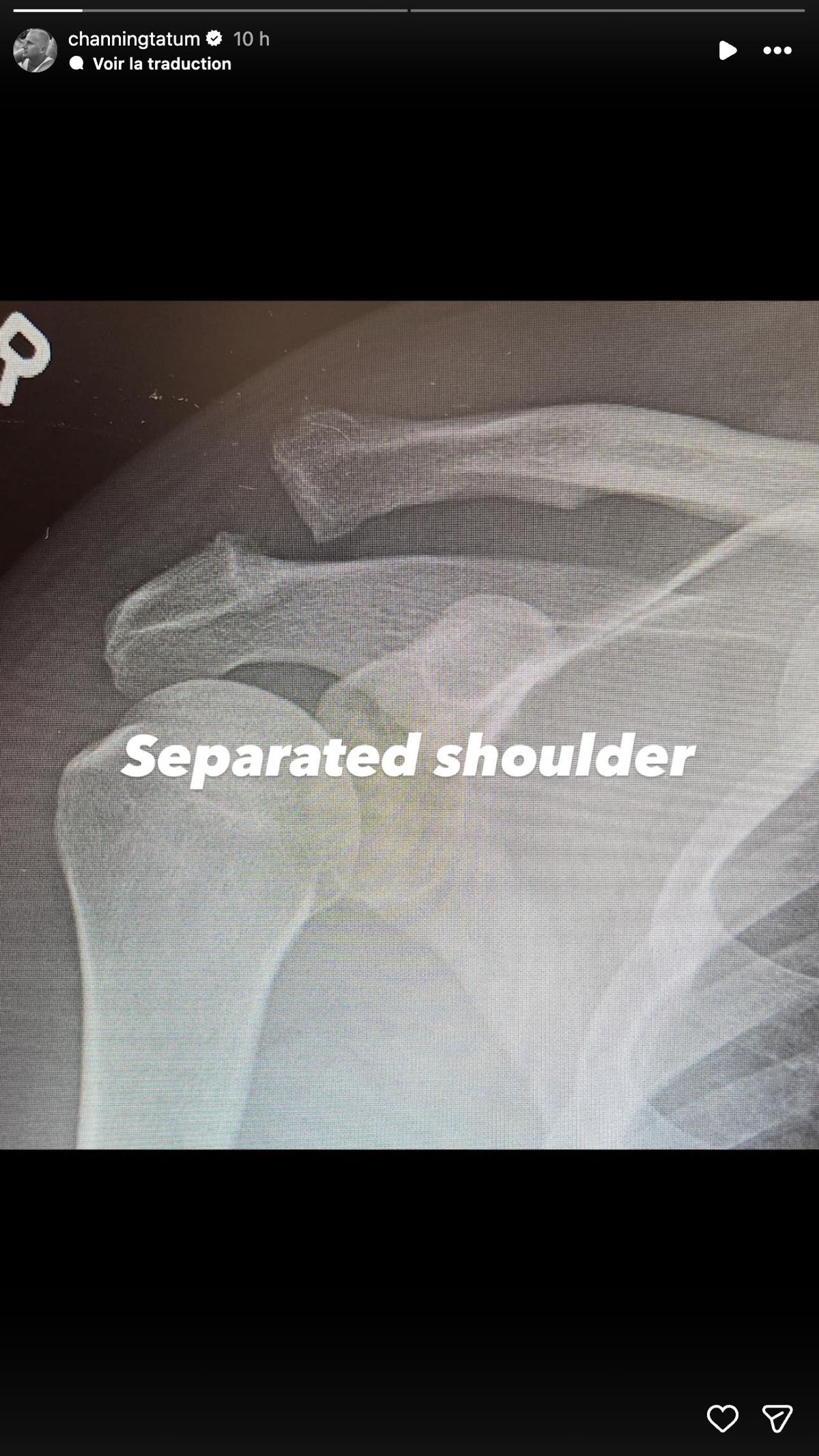 Channing Tatum s'est blessé à l'épaule