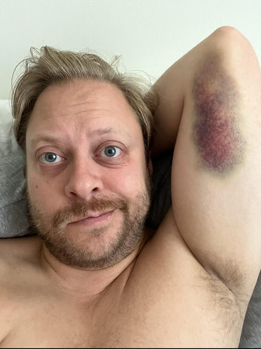 Guillaume Lambert montre sa blessure au bras